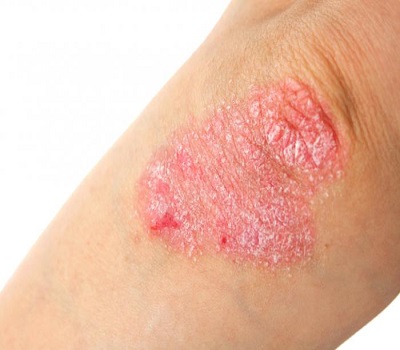 Psoriasis treatments in Mecode Asans Vaidhyasalai