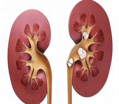 Kidney Stone treatments in Mecode Asans Vaidhyasalai